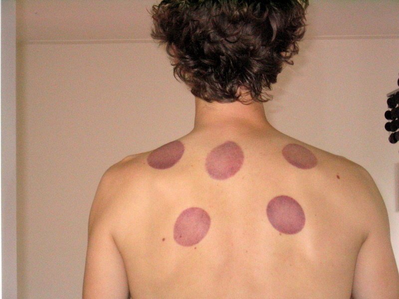 cupping results